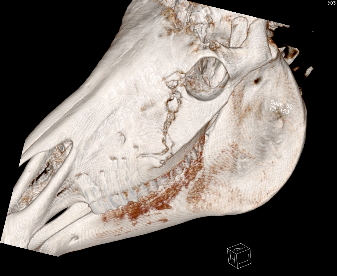 3D CT-Rekonstruktionsbild, welches ein Bruch des Schädelknochens Knochens darstellt.