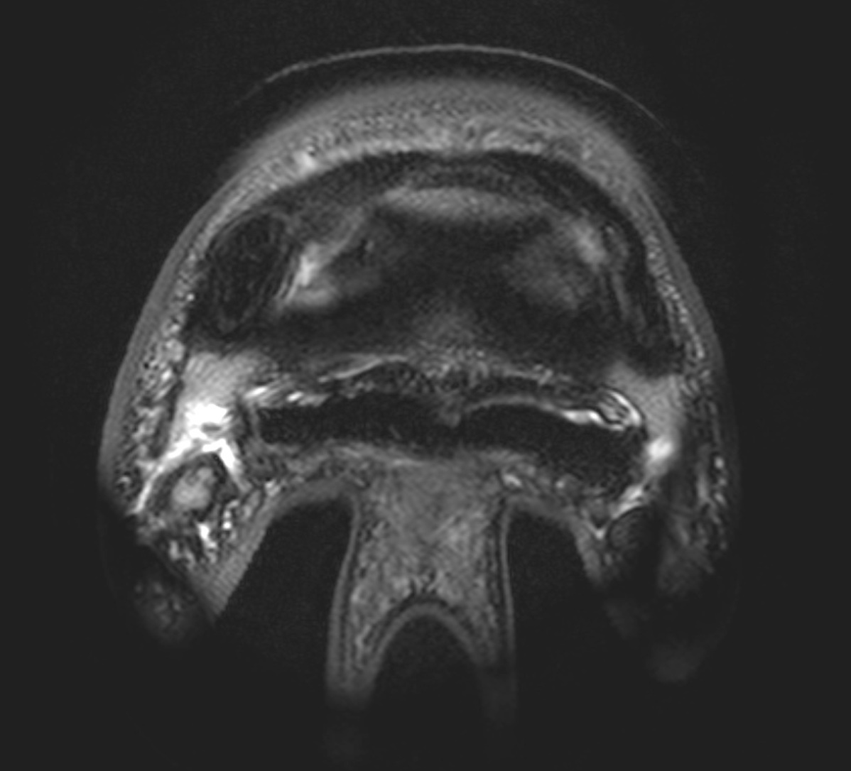 MRI Querschnittbild eines Pferdes mit einer Seitenbandpathologie des Hufgelenkes.