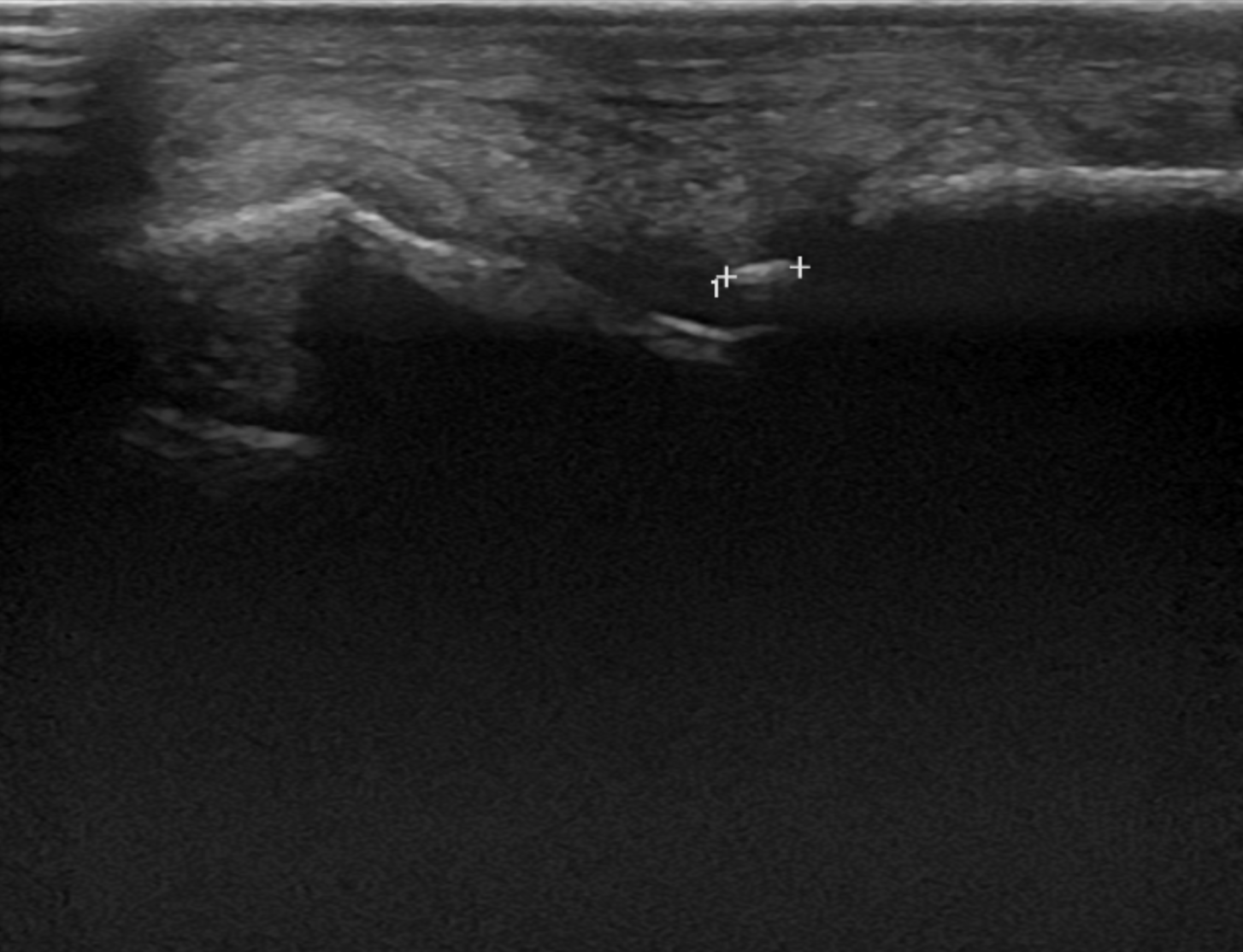 Ultrasonographische Darstellung eines Chips in einem Fesselgelenk.