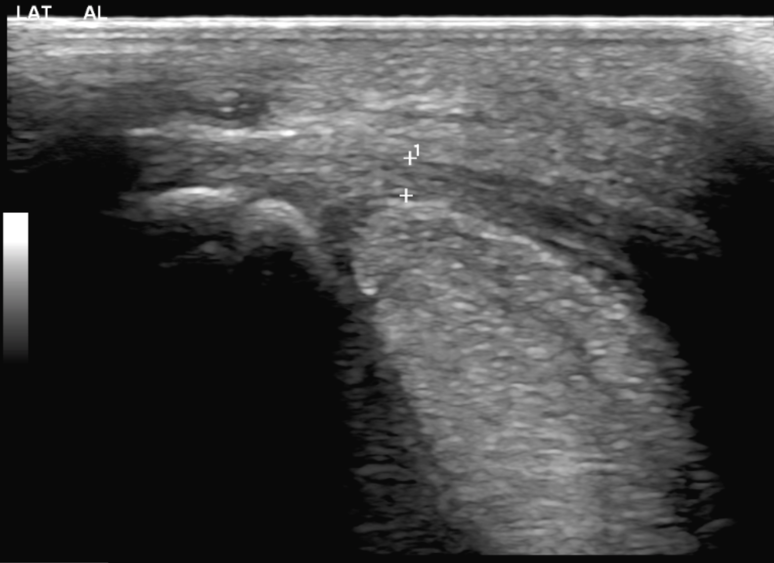 Ultrasonographische Darstellung eines Fesselringbandes.