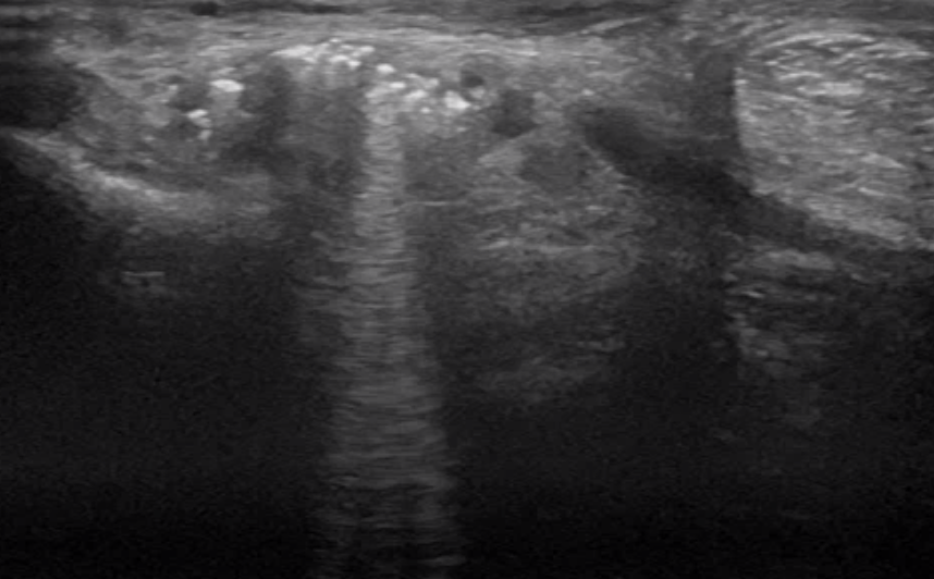 Ultrasonographische Darstellung eines septischen Gelenksergusses (sichtbar als weisse Stippchen mit dem Schallschatten).