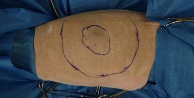 Das Bild zeigt das heutige Goldstandard-Vorgehen zur Operation einer Katze mit Fibrosarkom. Die Katze ist im OP Steril abgedeckt, der Kopf ist links, der Schwanz rechts und das Tier liegt auf der Seite. Der innere Kreis zeigt die Ausdehnung des Tumors die man fühlen kann. Der äussere Kreis zeigt den Sicherheitsabstand von 5 cm darum herum, und somit das Gewebe das (inklusive Haut und unterliegenden Muskeln) entfernt werden muss. Nach einer solchen OP bleiben die meisten Tiere 2-3 Tage bei uns stationär um eine gute Schmerztherapie zu gewährleisten.