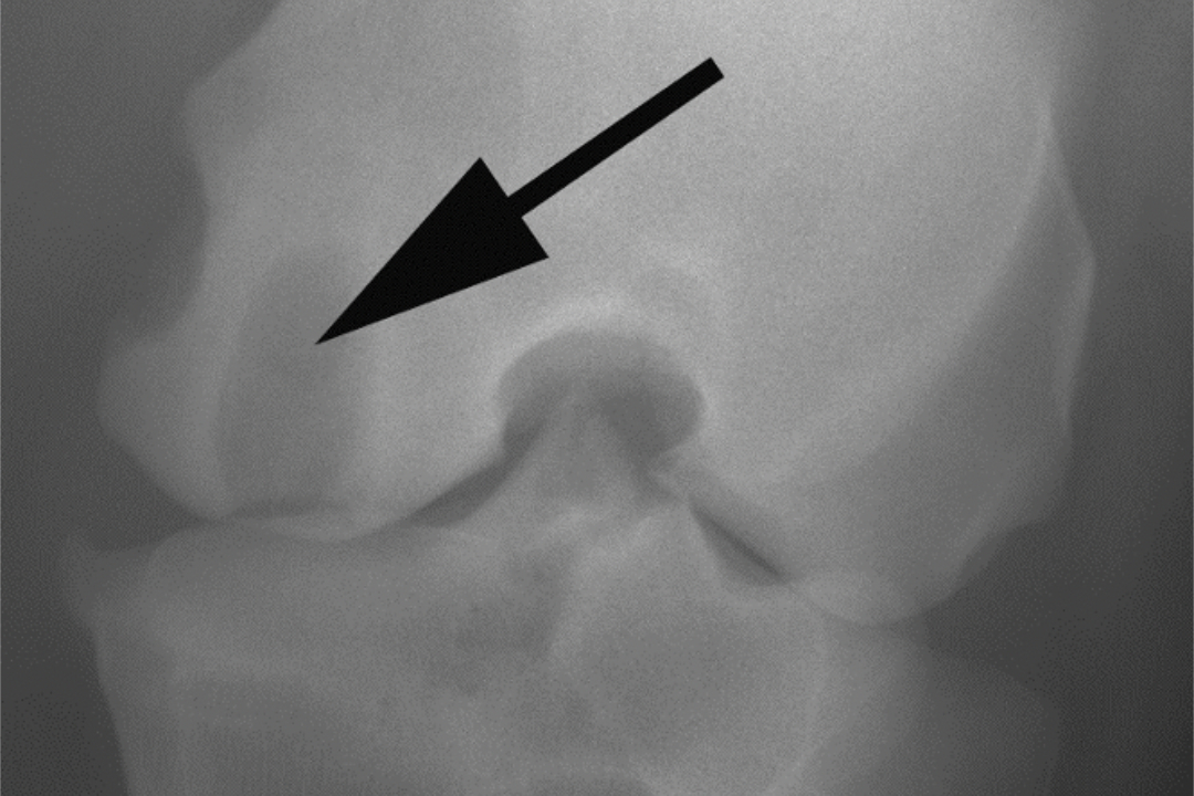 Dieses Bild zeigt ein Röntgenbild eines Pferdes mit einer Knochenzyste im medialen (Inneren) Kniegelenksbereiches.