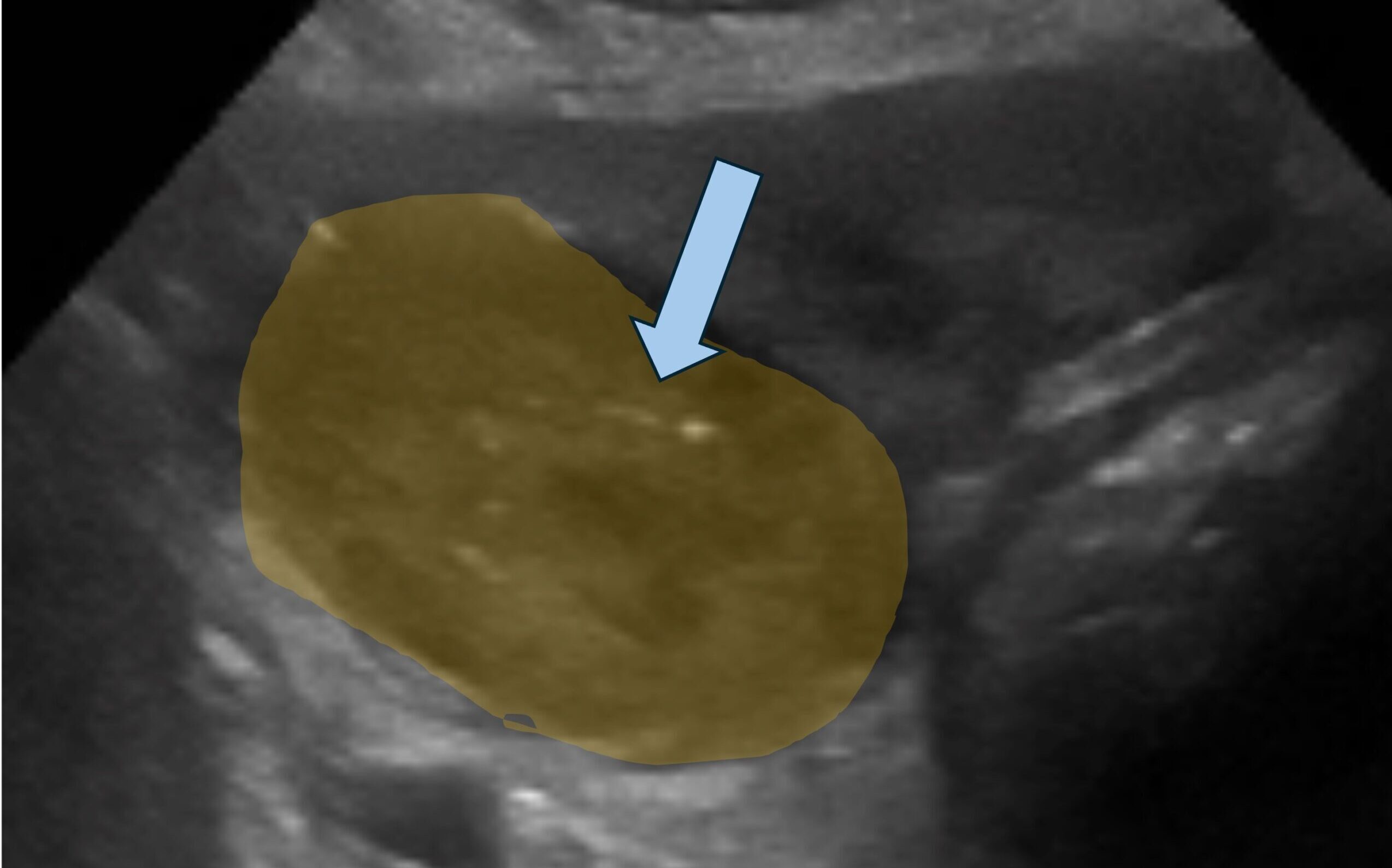 Das Ultraschallbild zeigt die vergrößerte Prostata (gelb unterlegt). Ein Verdacht auf ein Karzinom ergibt sich, wenn Verkalkungen (Pfeil) zu sehen sind. Eine Punktion schafft dann Sicherheit.